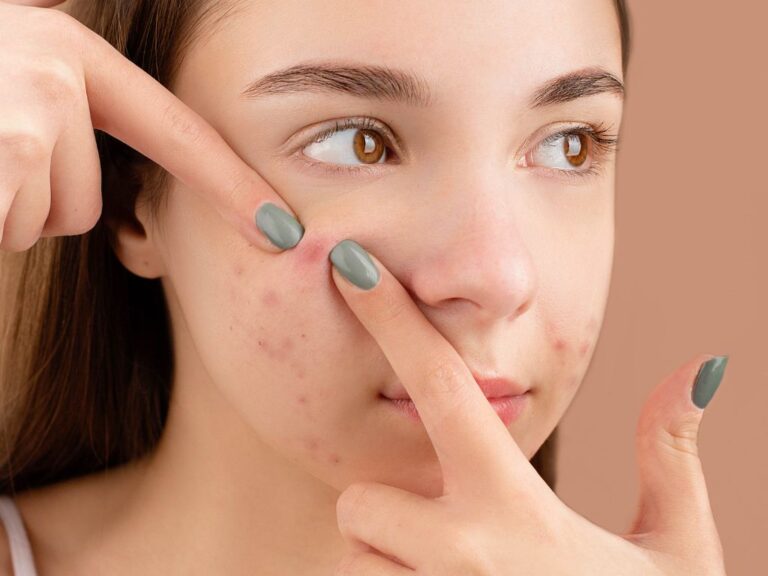 Can Coffee Cause Pimples