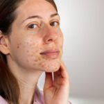 Can Coffee Cause Acne