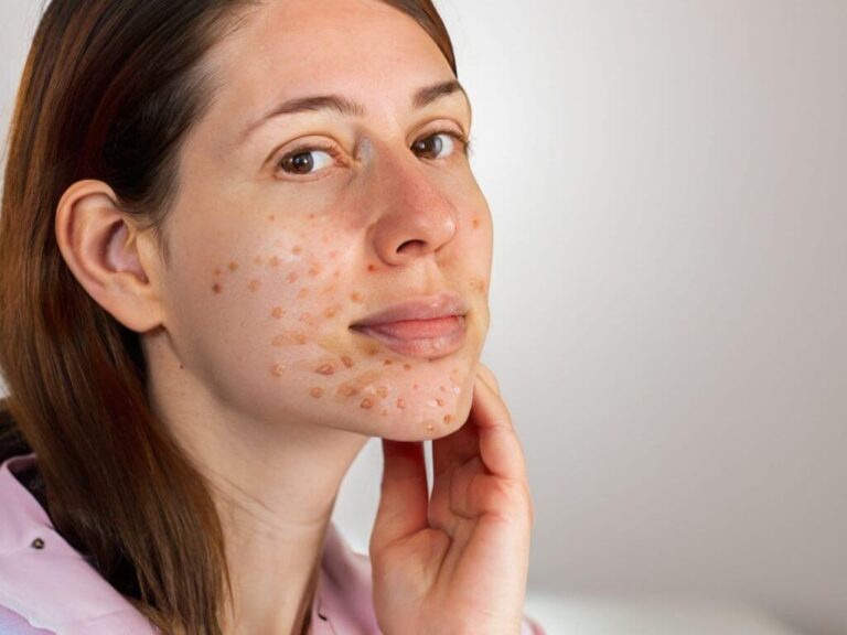 Can Coffee Cause Acne