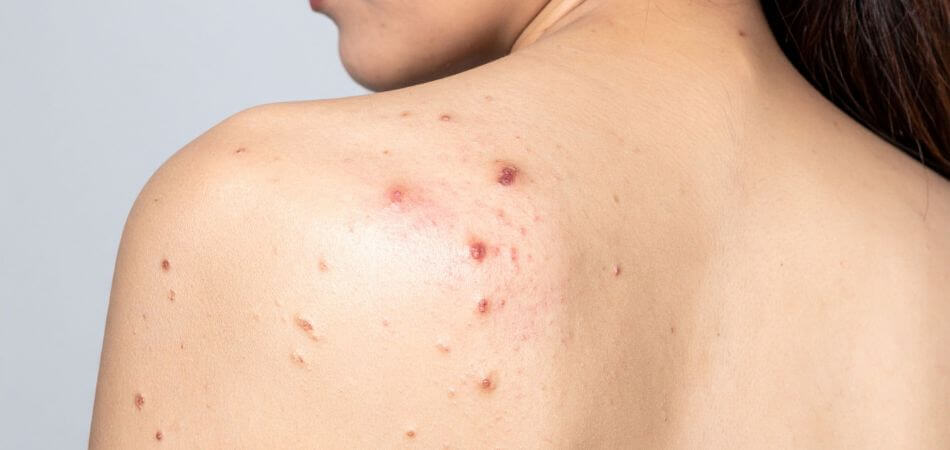 Can Coffee Cause Acne