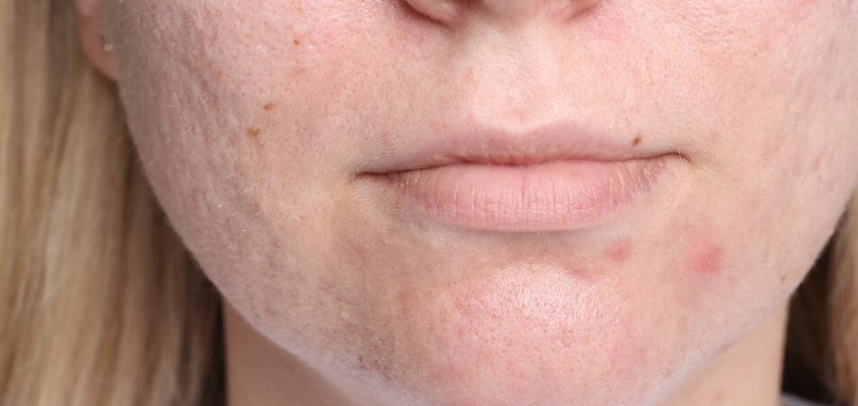 Can Coffee Cause Acne