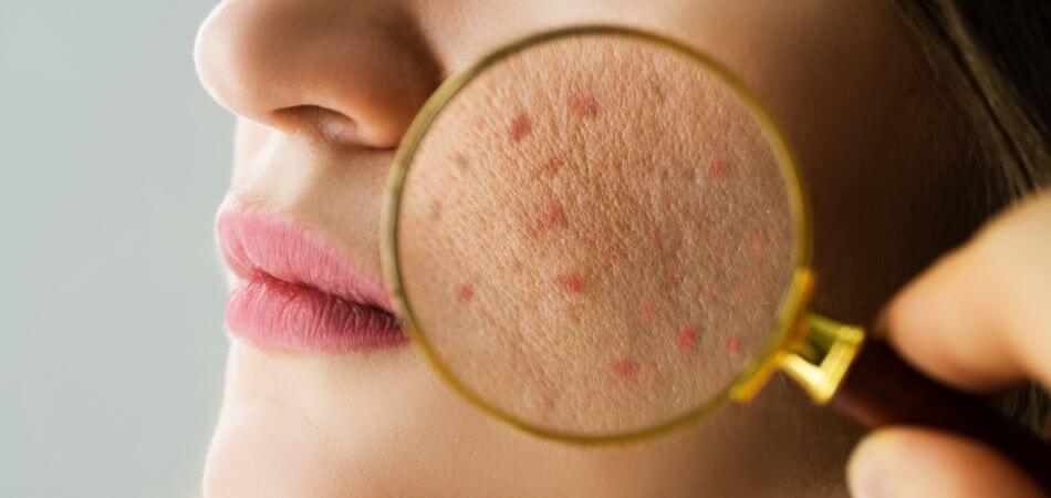 Can Coffee Cause Acne